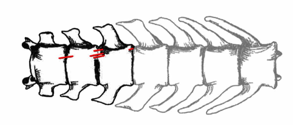 Schéma de localisation des traces de découpe fine sous le corps des vertèbres lombaires d'un chien de l'âge du Bronze ancien de Chabrillan (Drôme).
